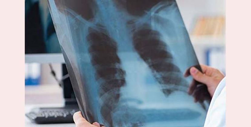 家庭主妇久咳逾月　检查才知罹肺癌