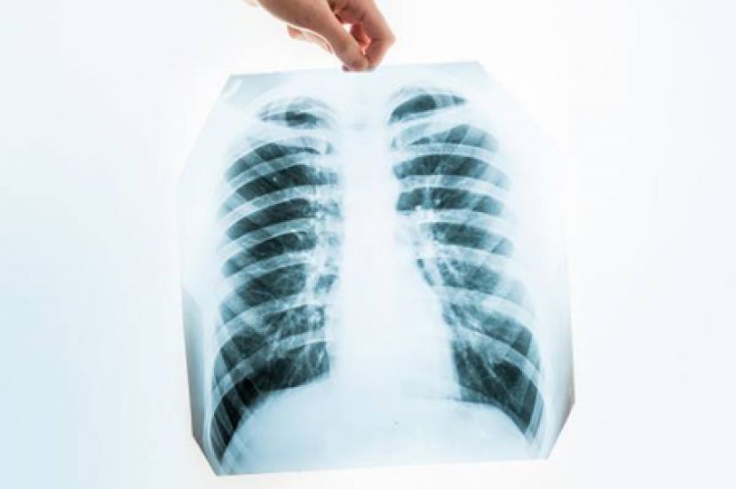 兼顾生活品质和安全 晚期肺腺癌也可出国旅行享受生活