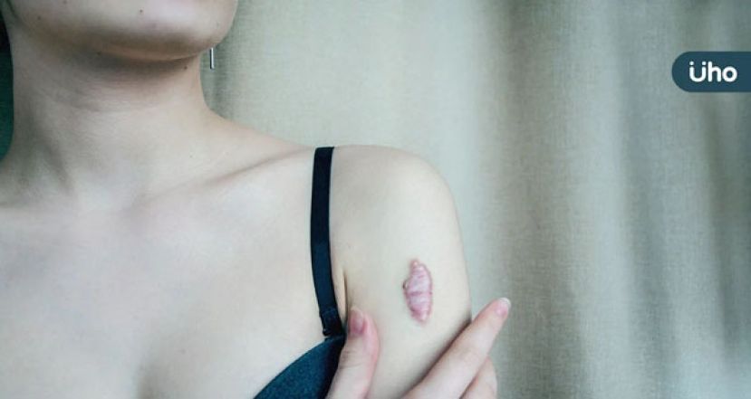 蟹足肿因皮肤反覆发炎感染　医示警：首先别熬夜