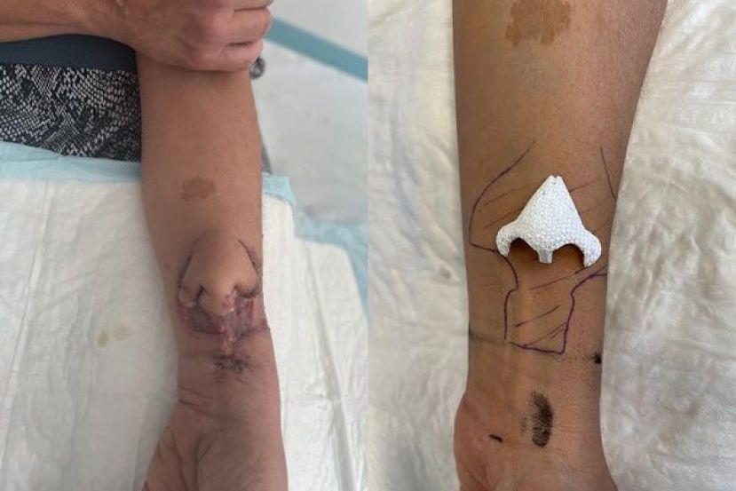 法国一位女病患靠著3D打印技术重建了一个新鼻子。