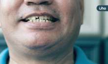 牙医教假牙清洁2招　防感染真牙流失