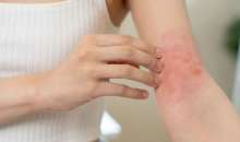 皮肤病打针好得比较快？　过敏是因肝不好？　皮肤科医破解3大迷思